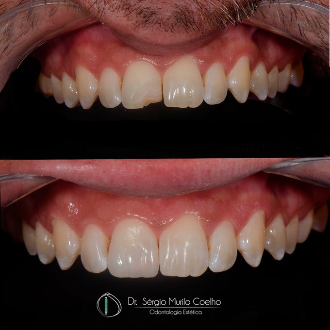 Antes e depois de restauração estética dental em Florianópolis
