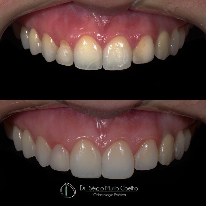 Antes e depois de lente de contato dental em Florianópolis